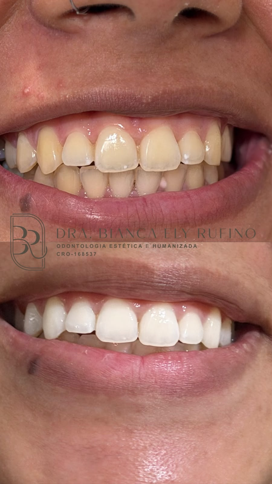 Clareamento dental