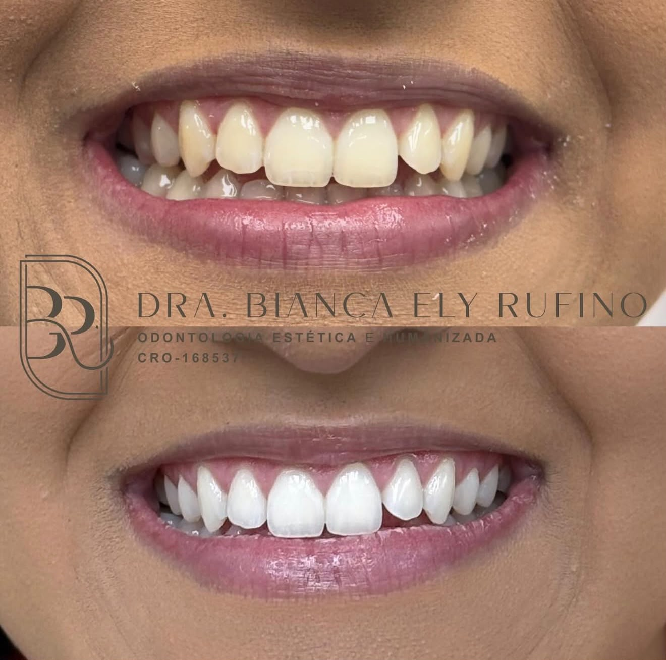 Clareamento dental