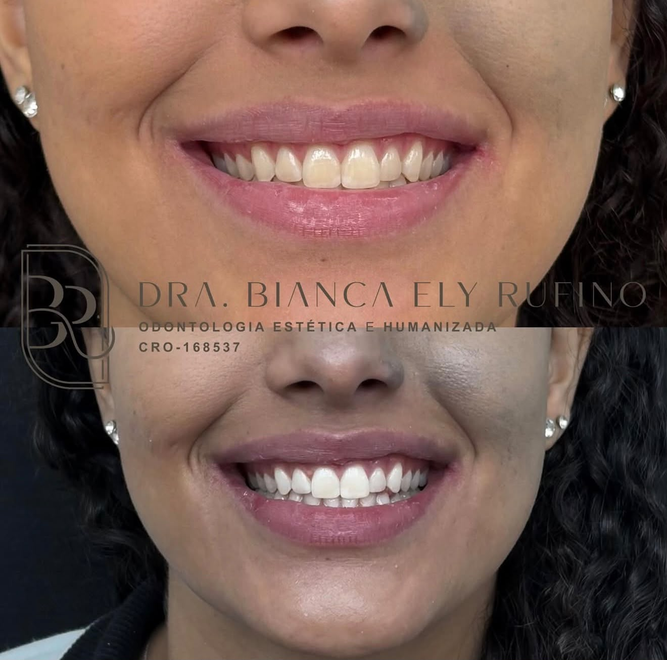 Resultado de Clareamento dental